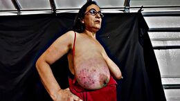 Tits bruised