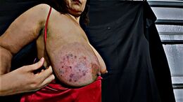 Tits bruised