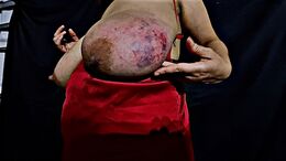 Tits bruised